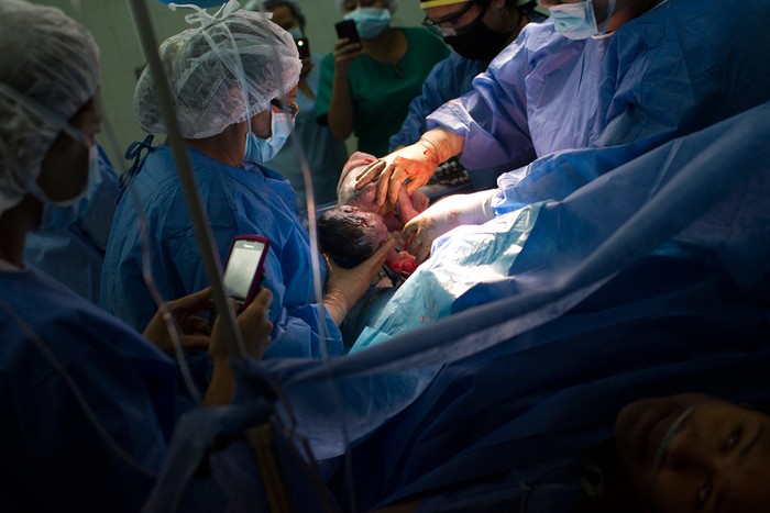 Một ca sinh thành công ở bệnh viện công Santa Ana, Caracas, Venezuela.